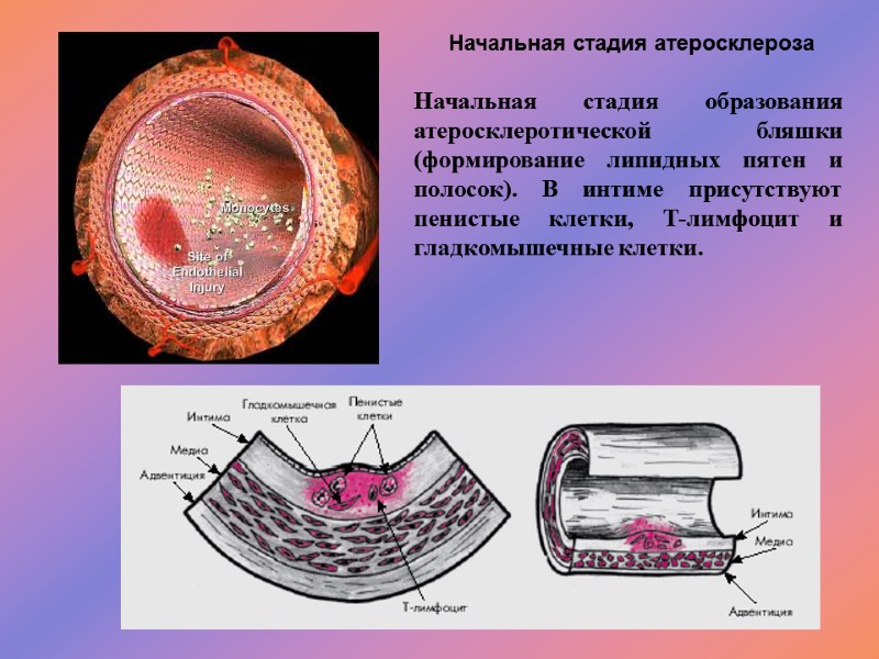 Начальная стадия образования атеросклеротической бляшки (формирование липидных пятен и полосок). В интиме присутствуют пенистые